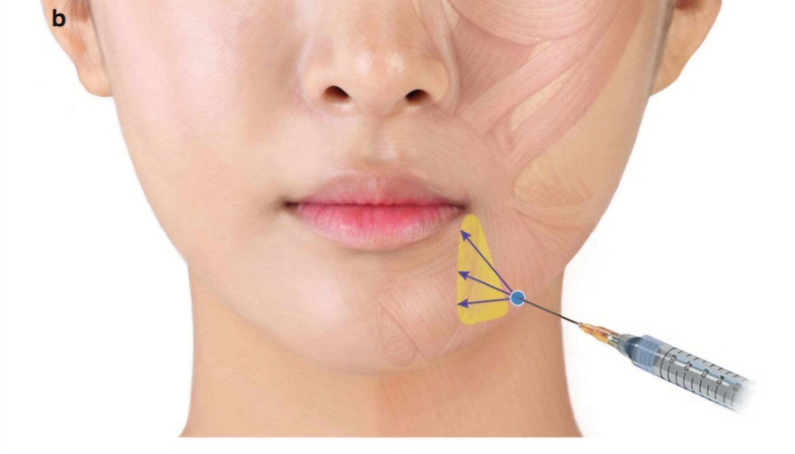 fillers markings