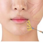 threadlifts