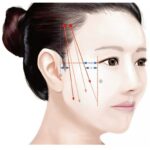 THREADLIFTS