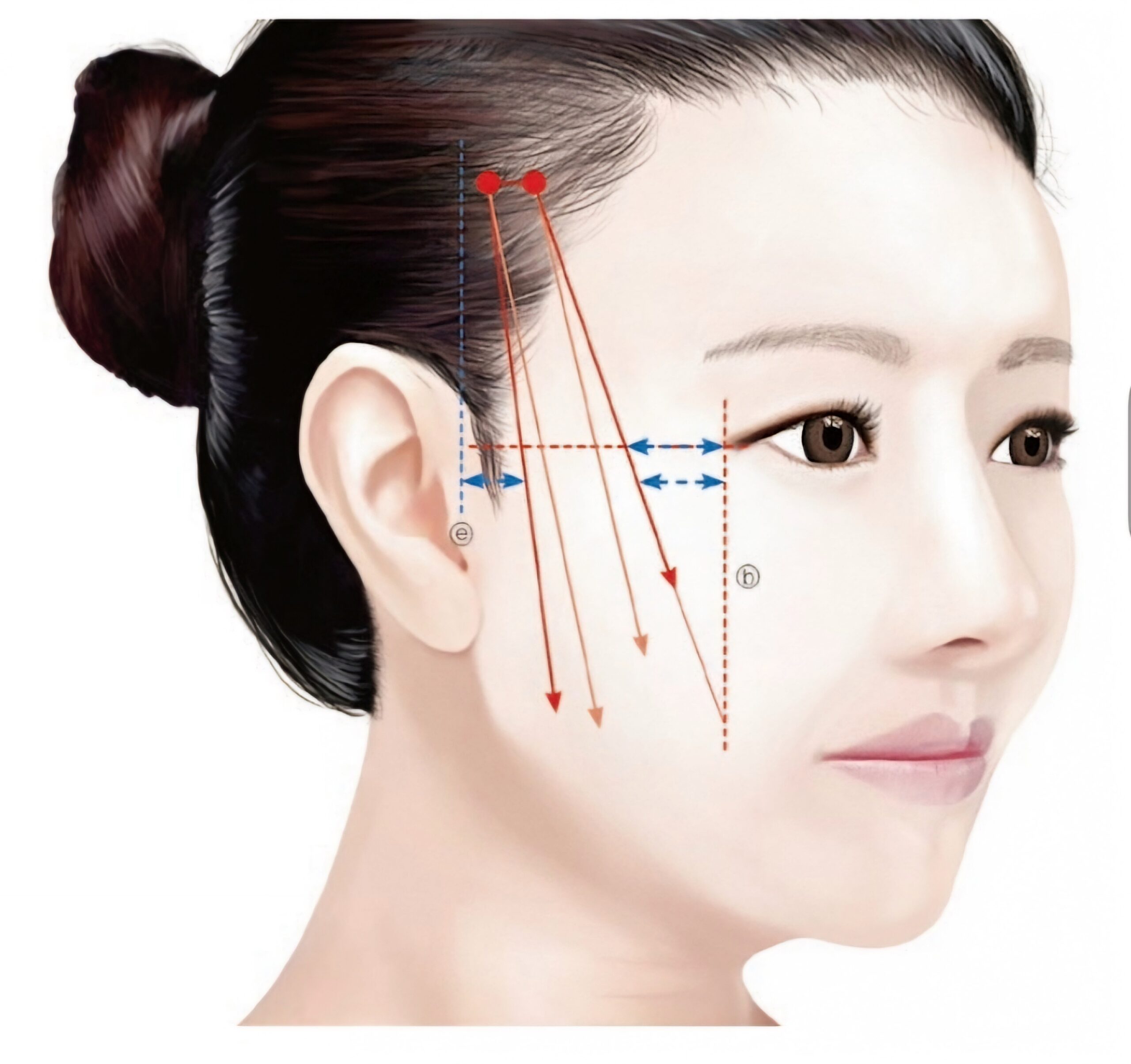 THREADLIFTS