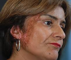 burn scar