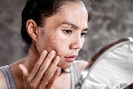 hyperpigmentation