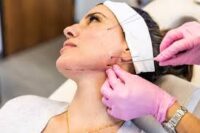 threadlifts