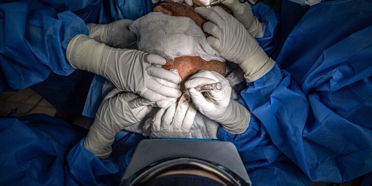 Hair transplant surgeon performing precision graft implantation during the IAMAC Master in Hair Transplantation hands-on clinical workshop.